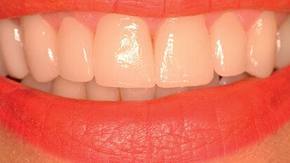 Estetica e CAD/CAM un binomio vincente