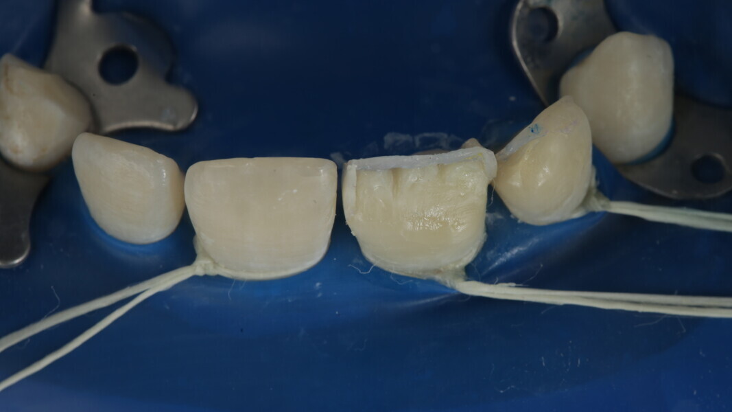 Fig 26: It was bulked up till the start of the bevel slightly covering the bevel.