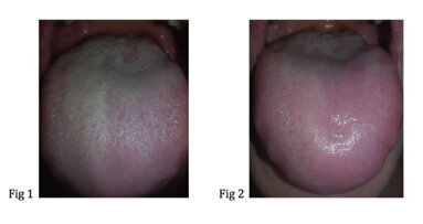 Trattamento con ossigeno terapia locale di un caso di lingua villoso
