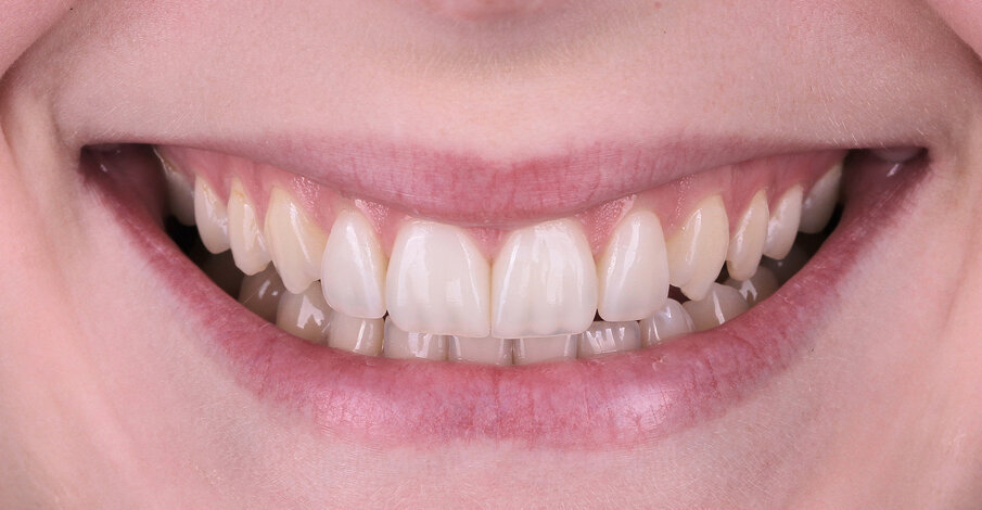 Fig. 12: Final situation – the new smile.