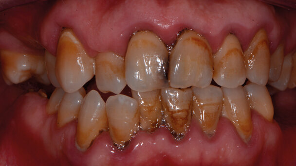 Carie e brown spot: il recupero dell’estetica del sorriso tra debridment, sbiancamento, infiltrazioni, ricostruzioni. Case report