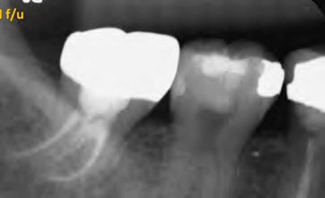 Fig. 2d: Fifteen-month follow-up radiograph demonstrating complete  periapical healing with normal bone architecture and successful long-term treatment outcome in the absence of clinical signs and symptoms.