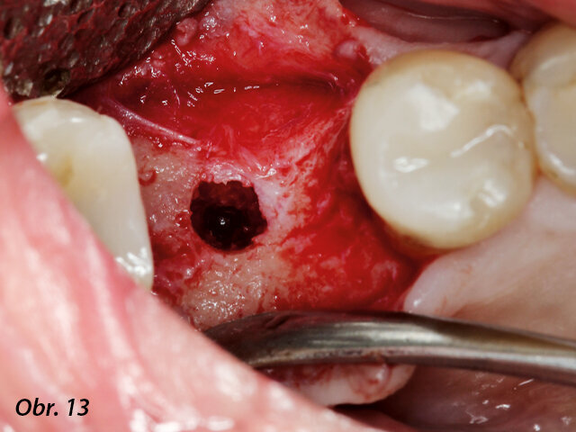 Dokončená osteotomie, štola připravena na zavedení implantátu.