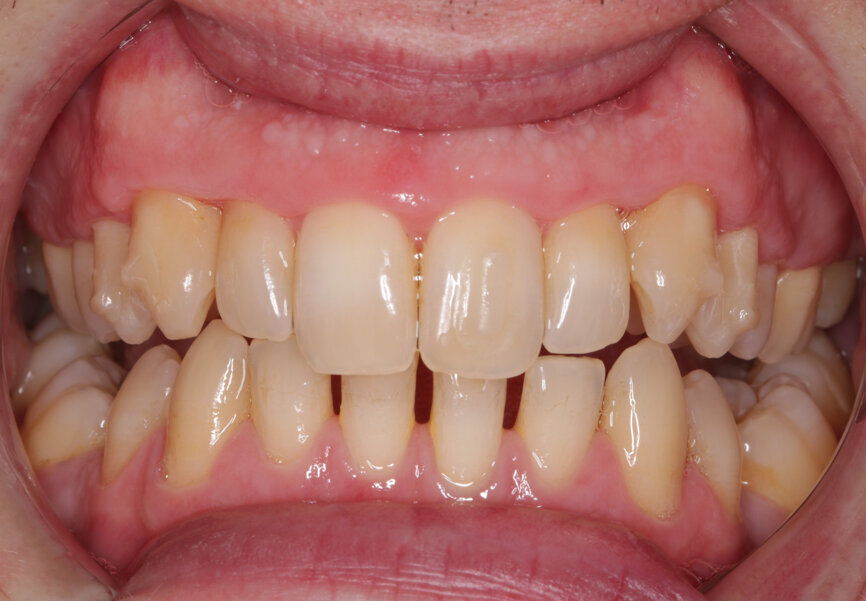 Fig. 10: Post-initial alignment, prior to refinement aligners anterior view