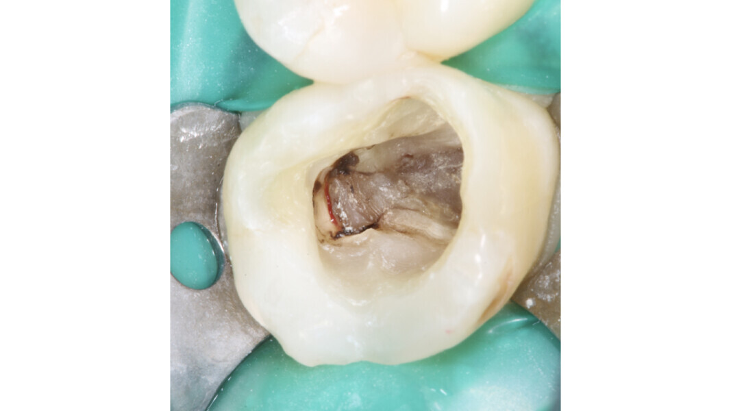 Fig. 3 : Agrégat important de résidus calcifiés de la cavité pulpaire obstruant complètement le canal palatin.
