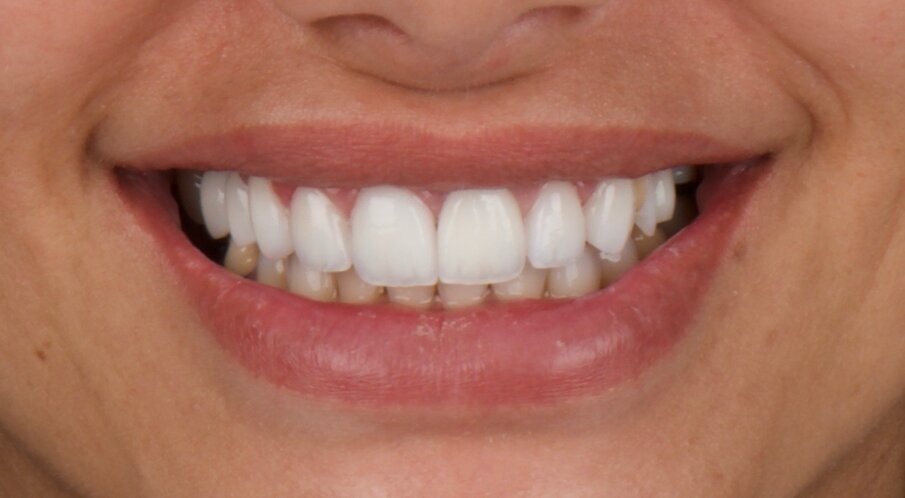 Fig. 24: Definitive restoration and healthy periodontal tissue.