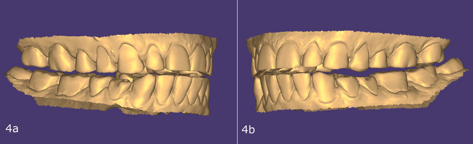 Figs. 4a–f: Design in exocad for posterior restoration.