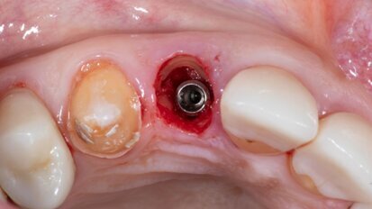 AI uncovers global trends in socket shield technique research