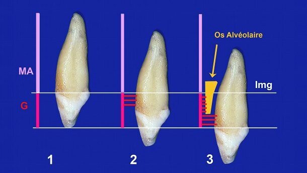 La canine incluse Désinclusion et parodonte
