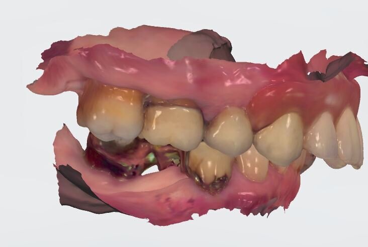 Fig. 5_Impronta digitale in occlusione visione laterale.