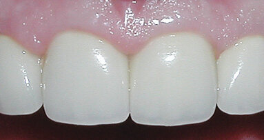 Clinical indications for a composite metal PFM restorative