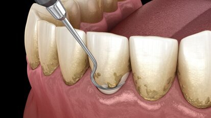 Periodontal healing may improve overall well-being via improved gut health