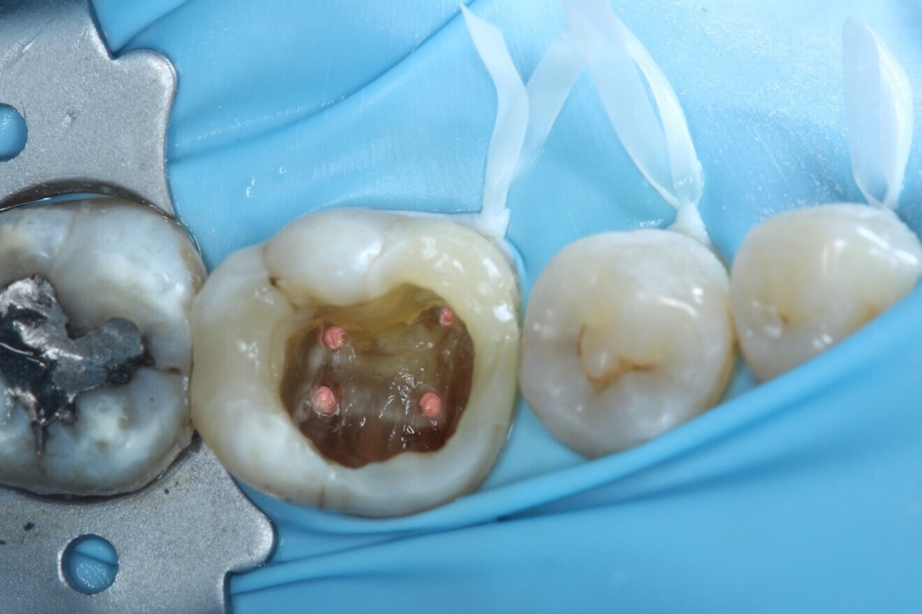 Fig. 14: After obturation.