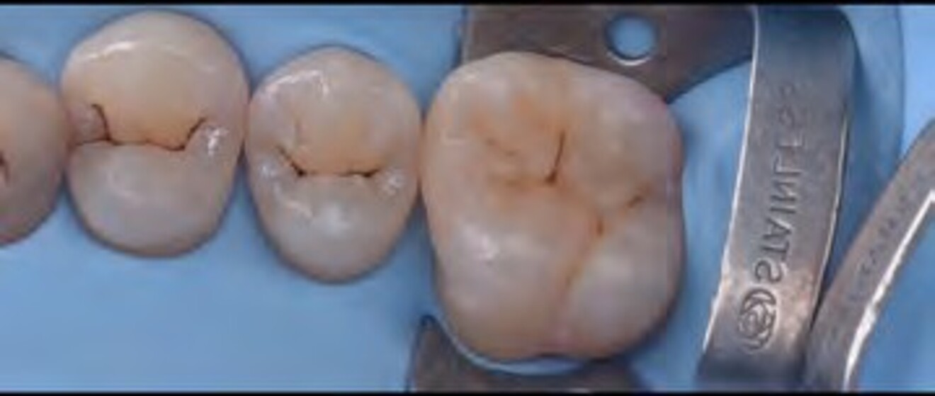  Fig. 3f: Final postoperative view under rubber dam isolation prior to removal, confirming complete restoration of form, contour, and occlusal anatomy.