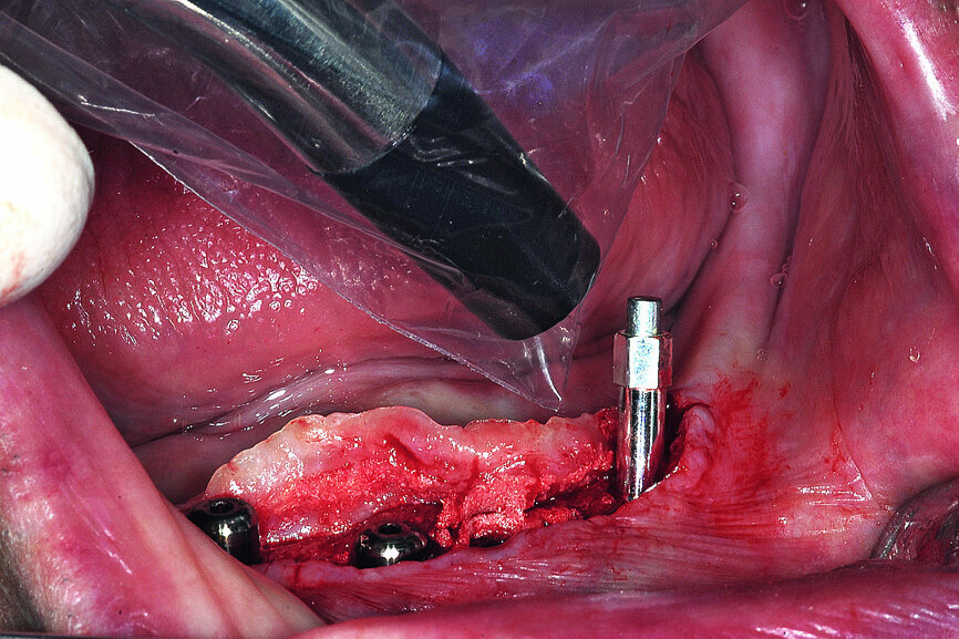 Fig. 19c: Healed site at three months (a). Uncovering of the integrated implants, healing collars and SmartPeg to measure ISQ values postoperatively (b). SmartPeg measuring ISQ values at uncovering (c).