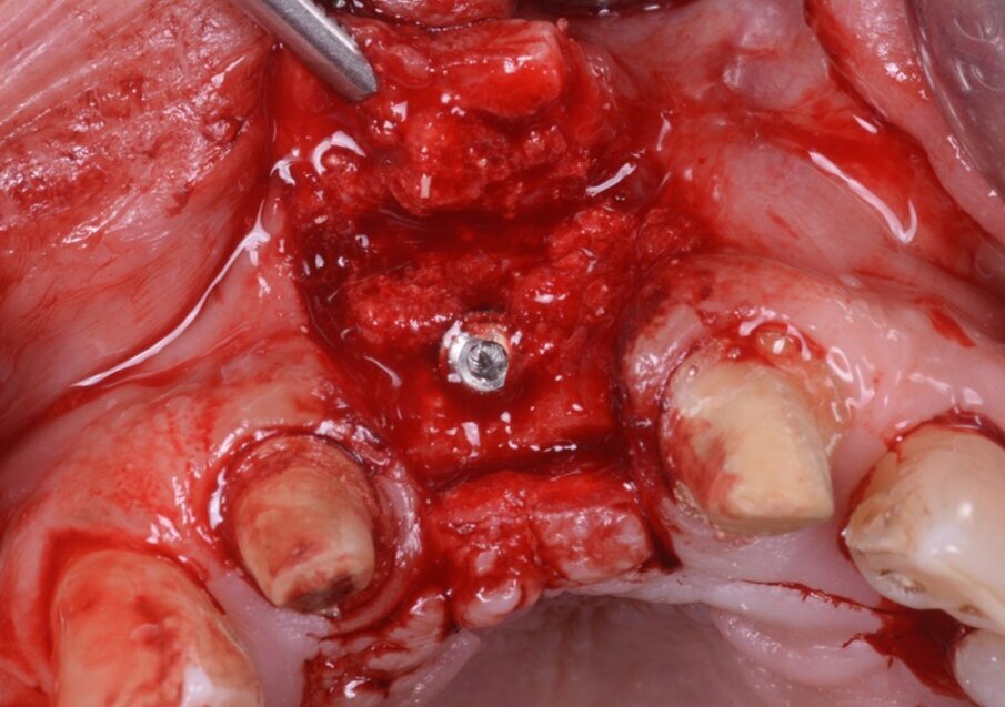 Fig. 19_L’impianto è stato inserito, l’osso raccolto durante la preparazione del sito recuperato ed utilizzato per riempire vestibolarmente.