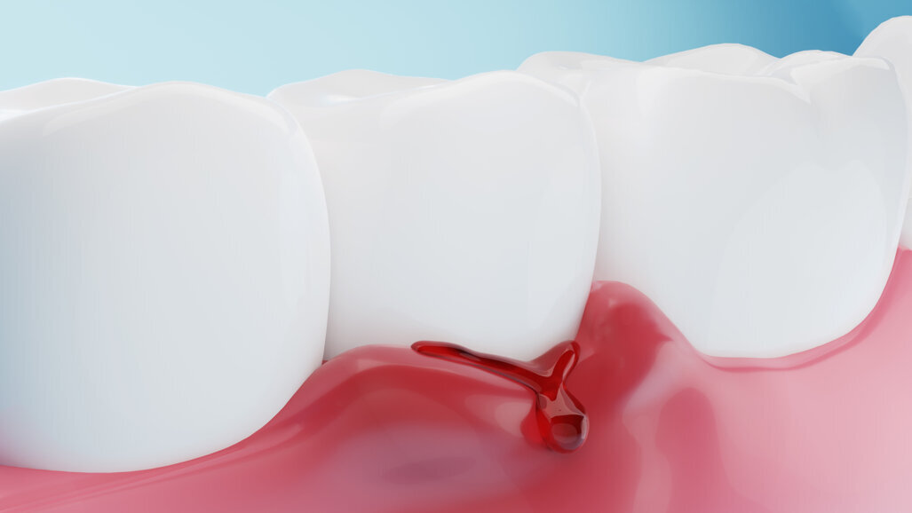 Study uses artificial intelligence for gingivitis detection