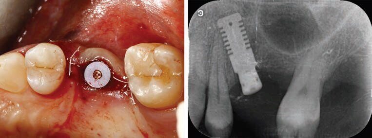 Fig. 6 - Fine chirurgia.