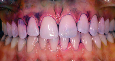 Efficacia ed efficienza del controllo del biofilm orale: protocollo tailoring “personalizzato e condiviso”