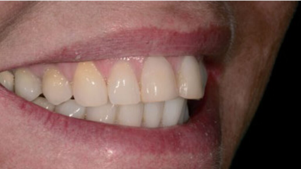 Indirect of direct restaureren: een binaire keuze?