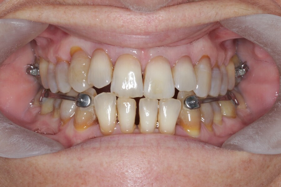 Fig. 33: Placement of the Carriere Motion 3D Class III appliance.