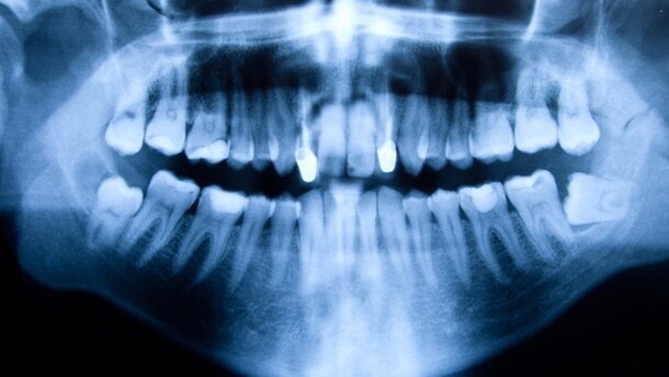 Baldiger Ersatz für Röntgenstrahlen?