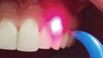 Curso Intensivo de Láser Aplicado a Odontología Moderna Curso Intensivo de Láser Aplicado a Odontología Moderna