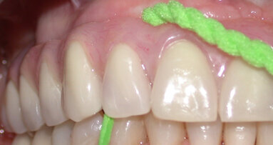 Deplaquing con un filo dotato di passafilo: esperienza clinica