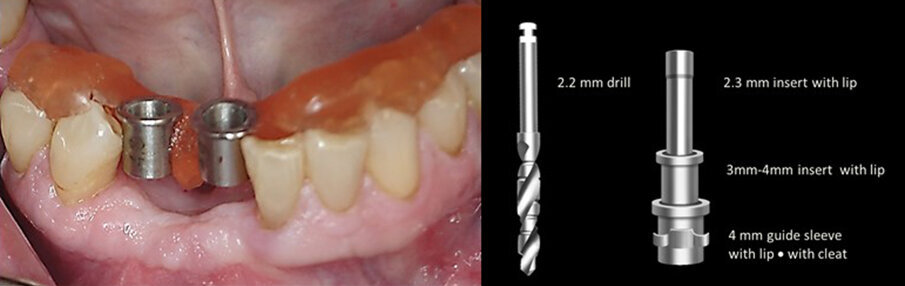 Figs. 12a & b: The corrected Guide Right surgical guide was tried into the mouth to verify t and stability (a). A 2.3 mm insert and a 3.0–4.0 mm insert were placed in the 4.0 mm guide sleeve before the 2.2 mm drill was used to start the osteotomy (b).