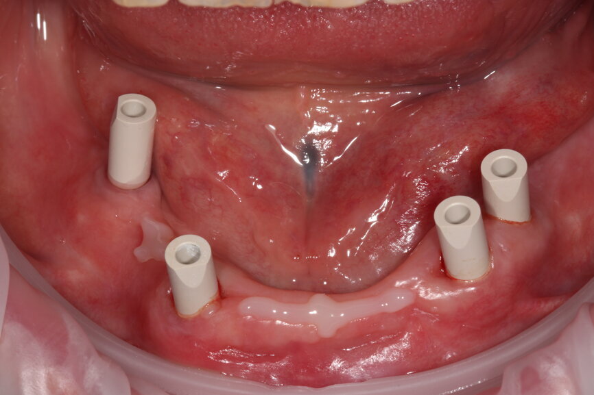 Fig. 14: Scanbodies with composite flow material to increase scan accuracy.