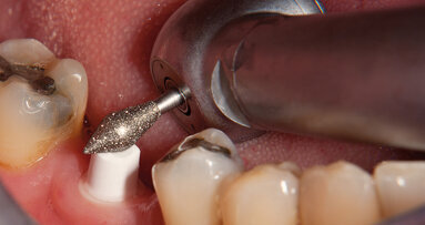 Fresas Z-Cut para repasar circonio