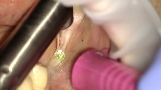 Odsłonięcie implantów przy użyciu lasera Er:YAG