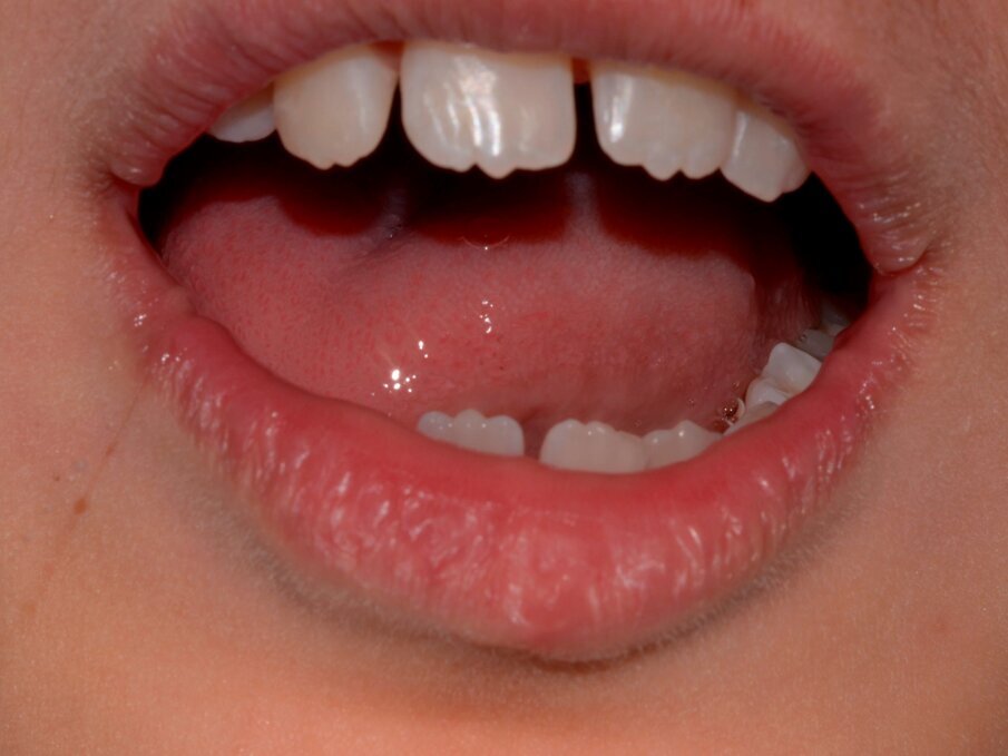 Figure 16: Lip healing one year on showed excellent soft tissue healing and an aesthetically good outcome following the suturing of the lip.