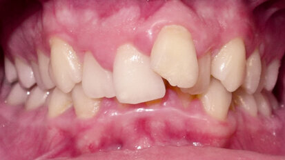 Neextrakční léčba závažného stěsnání pomocí cyklických sil a kortikotomií