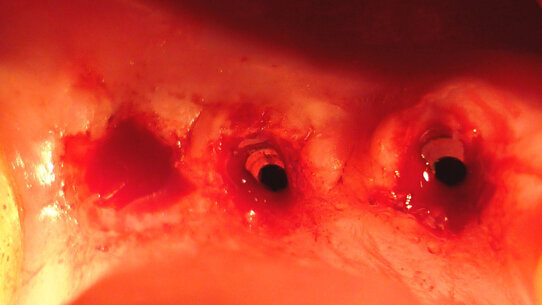 Aspetti clinici ed ergonomici dell’utilizzo del laser a diodi nella fase di scopertura implantare della tecnica “two stages”