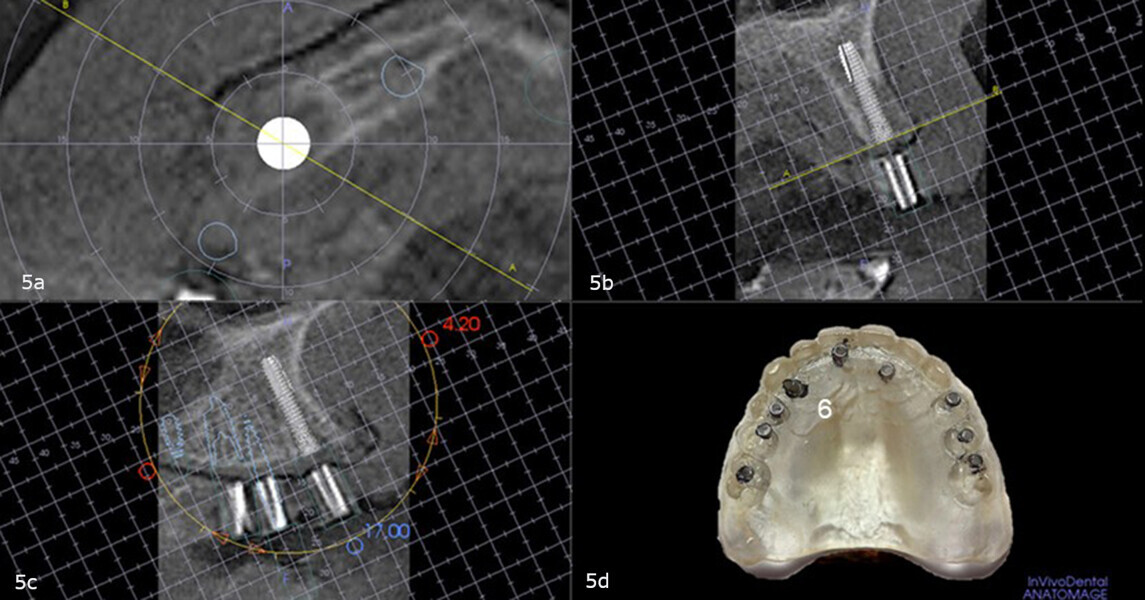 Figs. 5a–d: Virtual planning with the diagnostic guide placed intra-orally during the CBCT scan showing sufficient height of the maxillary right canine site to accommodate an implant and no need for correction (a–c). Site on the duplicate denture (d).