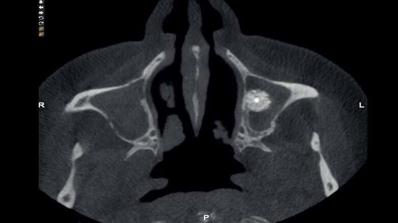 Complicaciones postoperatorias