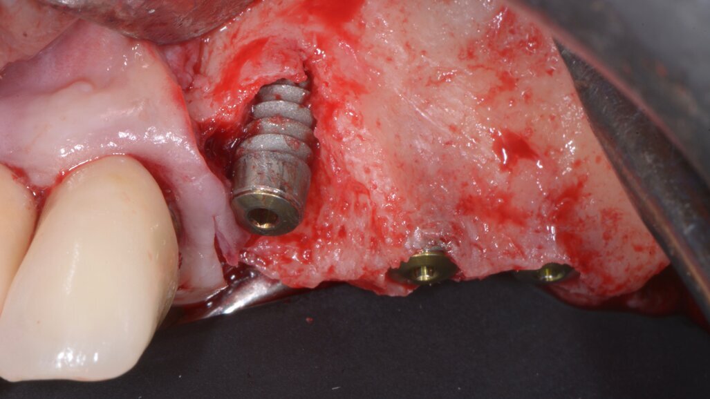 Osseodensificazione, tecnica innovativa per l’elevazione crestale del seno mascellare: Case Report