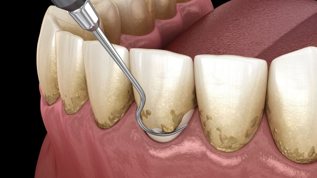 Periodontal healing may improve overall well-being via improved gut health