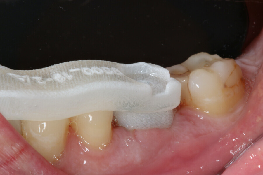Fig. 12: Abutment seating using insertion guide.