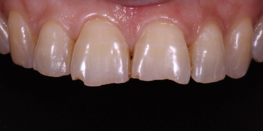 Fig 5: Pre op showing fractured incisal edges