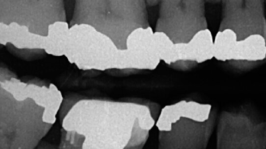 Gestione dei molari superiori