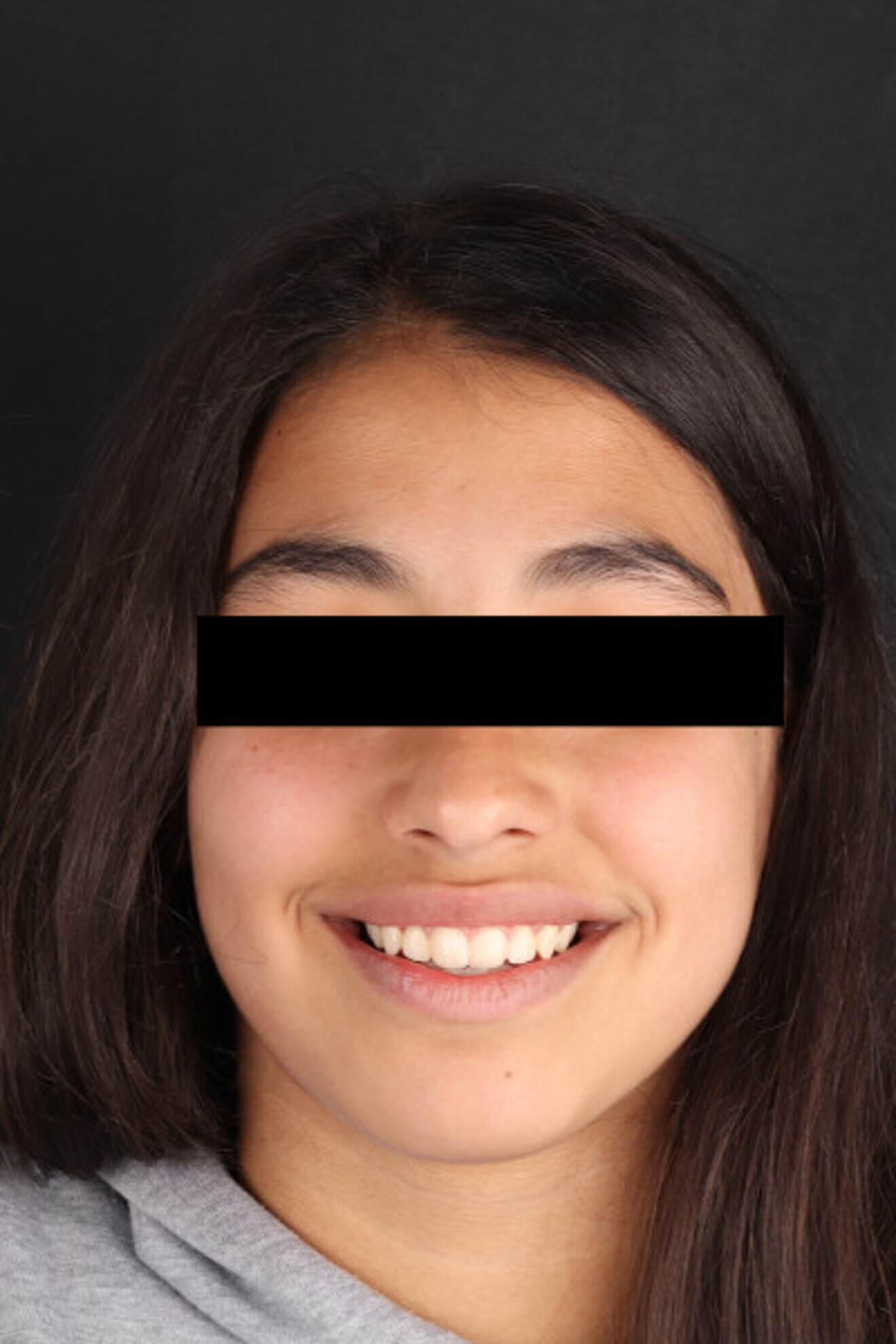 Fig. 26: Extra-oral clinical photograph showing the patient’s smile before treatment.