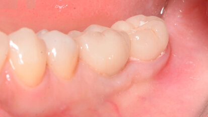 Technique Snake dans le traitement des défauts des tissus mous péri-implantaires postérieurs