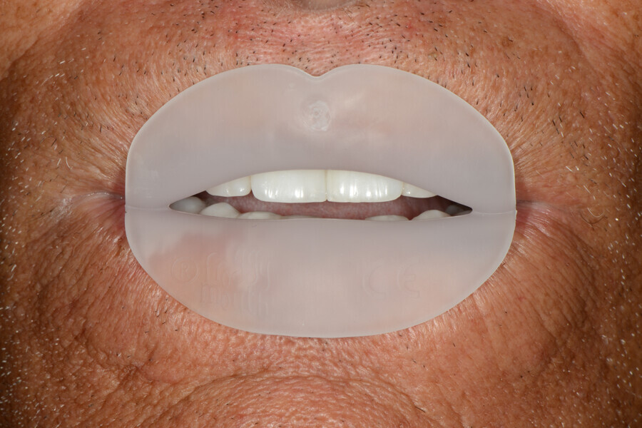 Fig. 28: Continued therapy with Froggymouth.