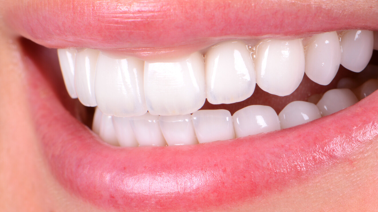 Fig. 32: Final smile after completion of treatment.
