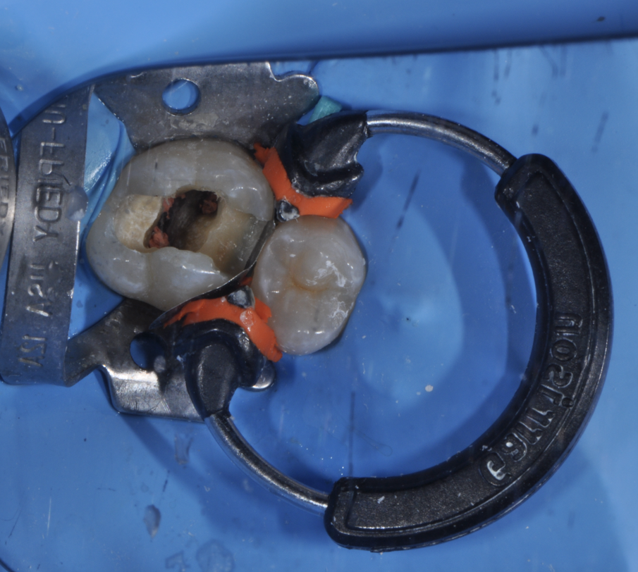 Fig. 5 - Foto occlusale intraoperatoria dell’isolamento durante le fasi del restauro diretto.