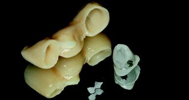 Caratteristiche del cemento ideale per sovrastrutture implantari