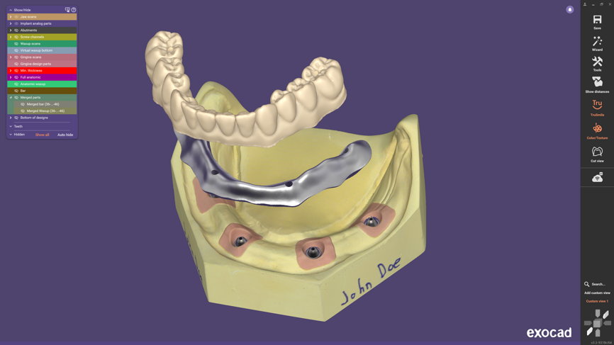 New workflow for split denture design.