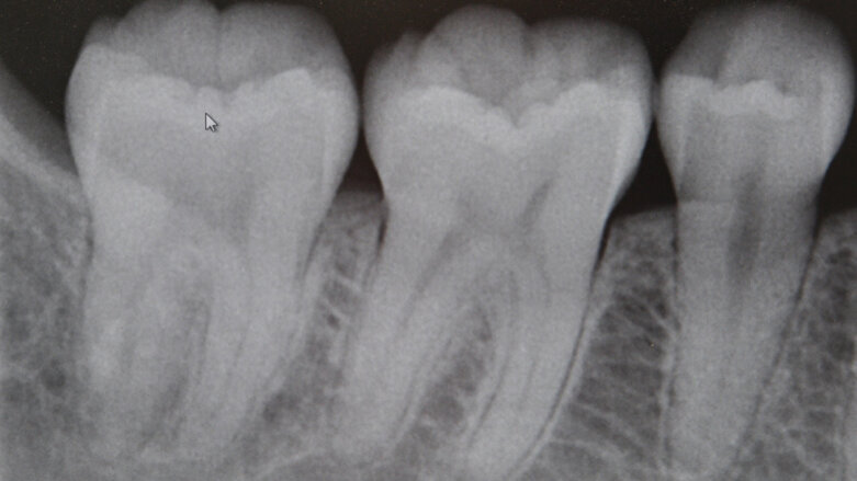 Vitamin-D-Mangel auf Röntgenbildern erkennbar